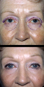 Bletheroplasty eyelid & eyebag reduction surgery